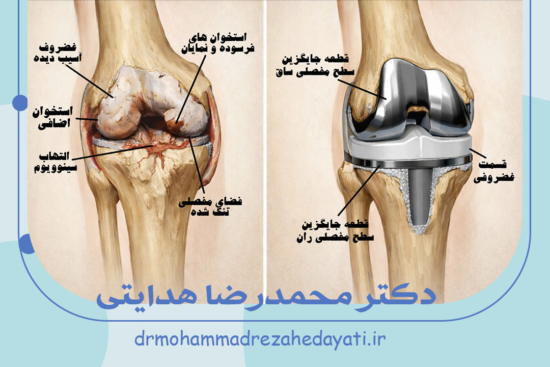 تعویض مفصل زانو